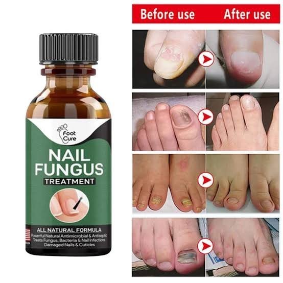 Nail Fungus Treatment