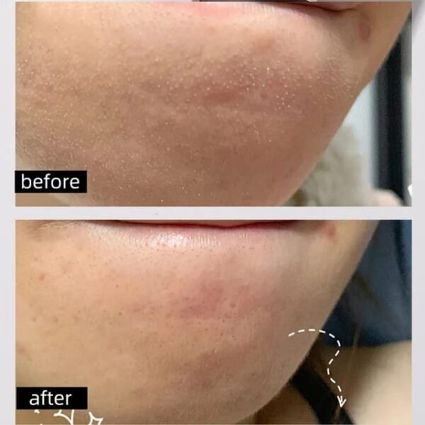 The Ordinary
Mariya Fruit Acid Facial Serum Peeling Solution AHA 30% + BHA 2% Nicotinamide Hyaluronic Acid Retinol Exfoliating Acne 30ML 
Original China 🇨🇳