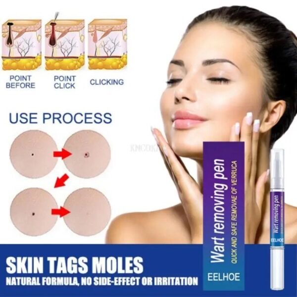 Wart Remover